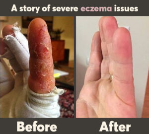a story of severe eczema issues 